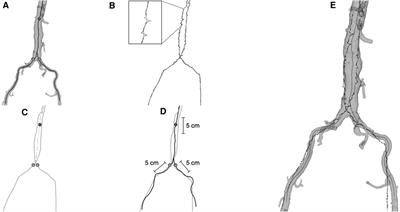 Endovascular navigation in patients: vessel-based registration of electromagnetic tracking to preoperative images